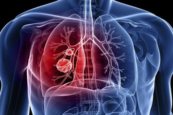 Campanha de Busca Ativa de Tuberculose 2019 – 2ª Fase