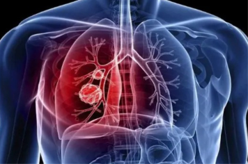 Itapetininga inicia 2ª fase da Campanha “Fique Sabendo Tuberculose 2025” com busca ativa e oferta de exame