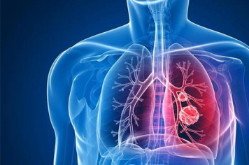 Itapetininga inicia Campanha “Fique Sabendo Tuberculose 2025” com busca ativa e oferta de exame